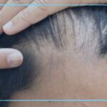 علاج الشعر الخفيف من الأمام.