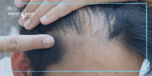 علاج الشعر الخفيف من الأمام.