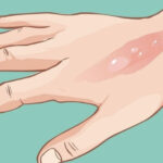 إزالة الحروق بالليزر في تركيا