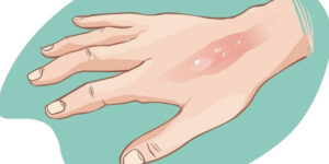 إزالة الحروق بالليزر في تركيا