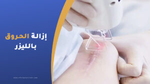إزالة الحروق بالليزر في تركيا