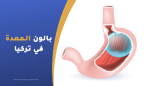 عملية بالون المعدة في تركيا