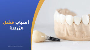 أسباب فشل زراعة الأسنان