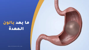 تعليمات ما بعد بالون المعدة