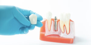 تعليمات ونصائح بعد زراعة الأسنان