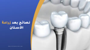 تعليمات ونصائح بعد زراعة الأسنان