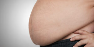 عملية التكميم لمرضى السكر