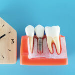 كم مدة زراعة الأسنان