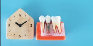 كم مدة زراعة الأسنان