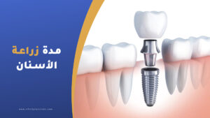 كم مدة زراعة الأسنان