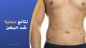 متى تظهر نتائج عملية شد البطن