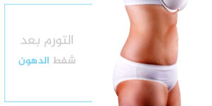 متى يزول التورم بعد شفط الدهون