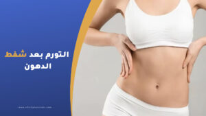 متى يزول التورم بعد شفط الدهون