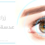 زراعة عدسة العين في تركيا