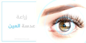 زراعة عدسة العين في تركيا