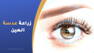 زراعة عدسة العين في تركيا