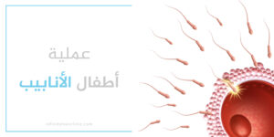 عملية أطفال الأنابيب في تركيا