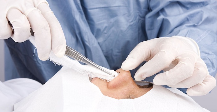 كيف تتم عملية تجميل الأنف بالخيوط