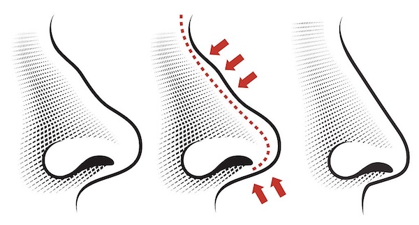 ما بعد تجميل الأنف