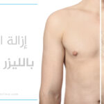 إزالة الشعر بالليزر للرجال