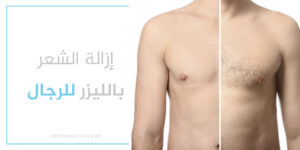 إزالة الشعر بالليزر للرجال