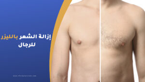 إزالة الشعر بالليزر للرجال
