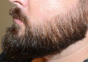 نتائج عملية زراعة الذقن