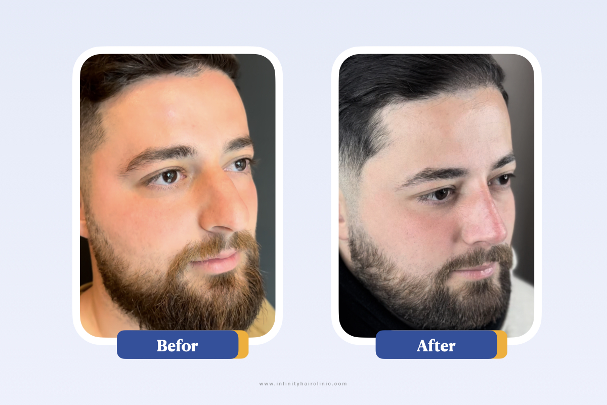 نتائج قبل وبعد تجميل الأنف.