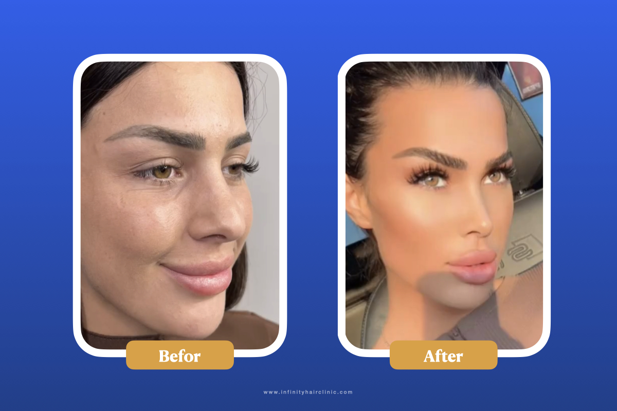 نتائج قبل وبعد تجميل الأنف.