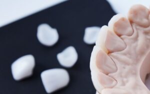 الفرق بين الفينير والزيركون وايهما أفضل