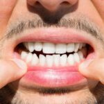 تجميل الأسنان في تركيا واسعارها