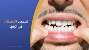 تجميل الأسنان في تركيا واسعارها