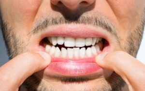 تجميل الأسنان في تركيا واسعارها