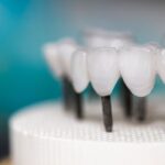 تركيبات الزيركون للأسنان