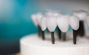 تركيبات الزيركون للأسنان