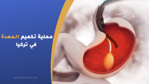 عملية تكميم المعدة في تركيا