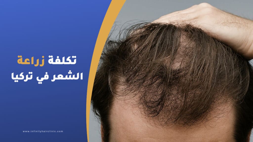 تكلفة زراعة الشعر في تركيا بالدولار وكافة العملات